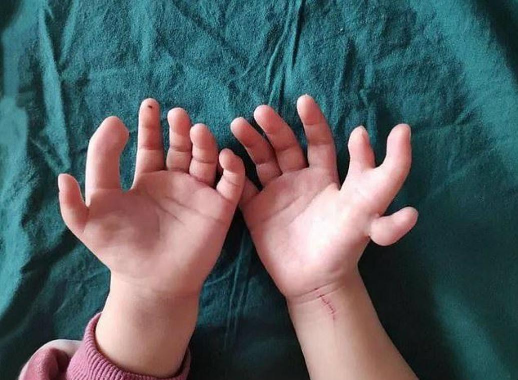 Une fillette née avec 14 doigts a été opérée avec succès