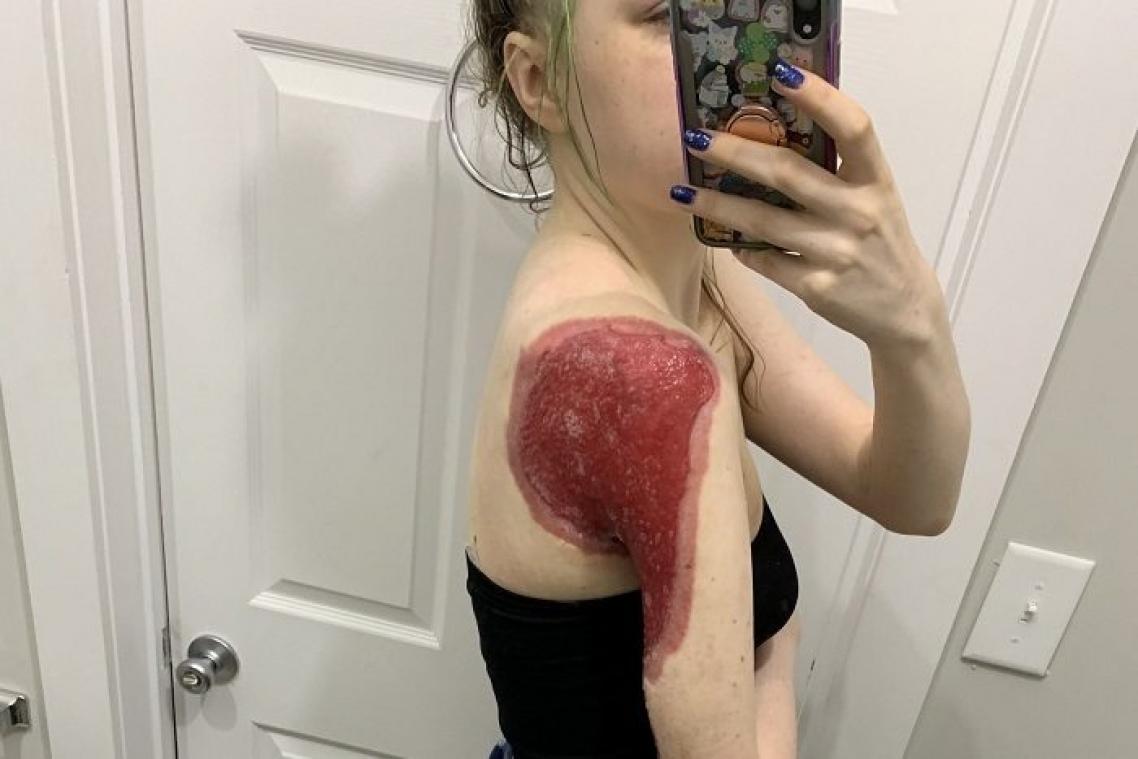 Une étudiante évite de justesse la mort après avoir mal nettoyé sa pompe à insuline