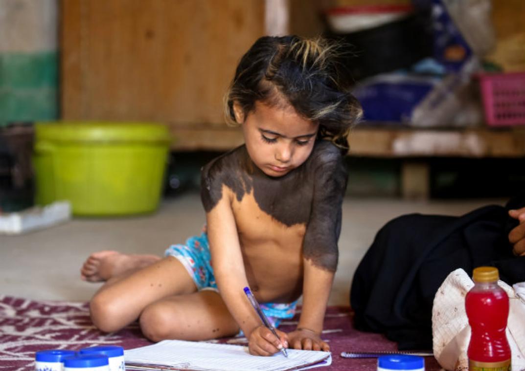 VIDEO. Une fillette irakienne mise au ban de son village à cause de sa maladie rare