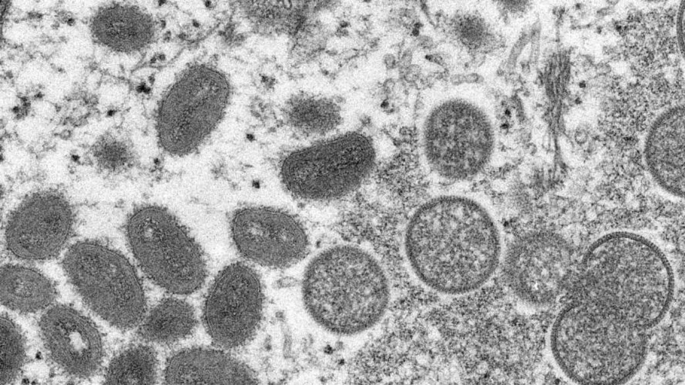 Dix-sept cas confirmés de variole du singe en Belgique