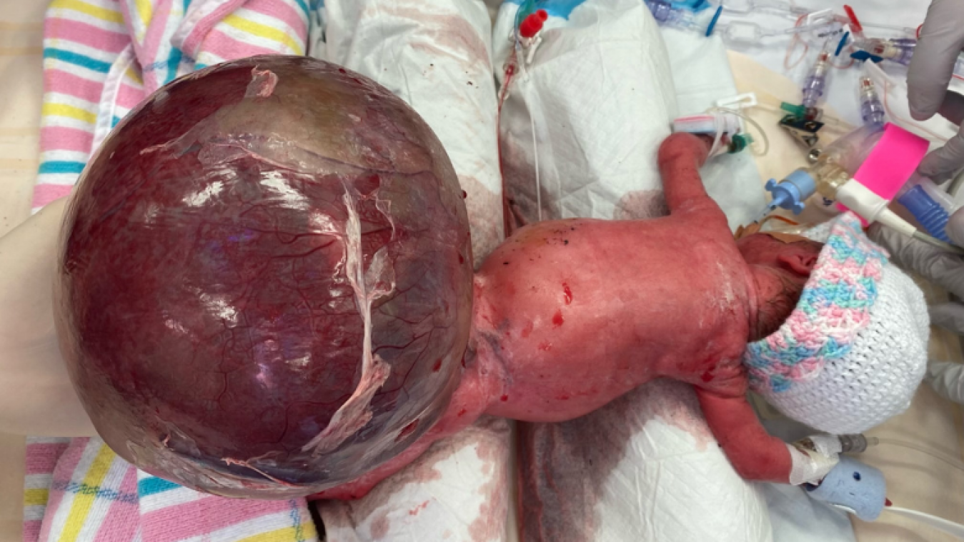 Né avec une tumeur deux fois plus grosse que lui, ce bébé a miraculeusement été sauvé (photos)